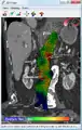 Biomechanical AAA rupture risk prediction