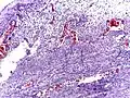 Micrograph of appendicitis showing neutrophils in the muscularis propria. H&E stain