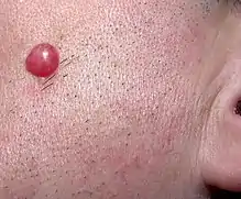 A solitary, large, red papule on the left cheek of an adult male