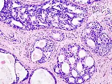 Ductal carcinoma in situ (DCIS) in breast tissue, cell nuclei (blue-purple), extracellular material (pink).