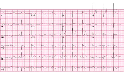 Type 2 Brugada ECG pattern