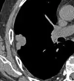 In this case, pleural retraction is seen as a triangular fat component.