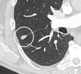 A triangular perifissural node can be diagnosed as a benign lymph node.