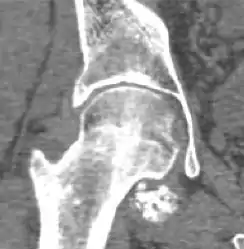 CT of synovial chondromatosis.