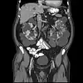 Abdominal CT scan of an adult with autosomal dominant polycystic kidney disease: Extensive cyst formation is seen over both kidneys, with a few cysts in the liver, as well. (Coronal plane)