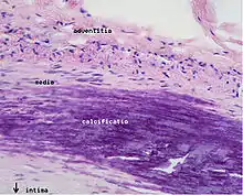 Microphotography of arterial wall with calcified (violet colour) atherosclerotic plaque (haematoxylin & eosin stain)