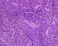 Anaplastic (microcellular, oat cell) carcinoma from the lung (histopathology)