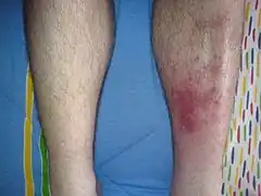 Cellulitis