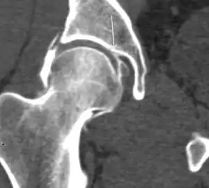 Coronal CT-arthrography (d) showing ligamentum teres tear.