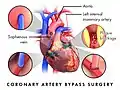 Coronary artery bypass graft