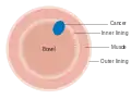 Dukes stage A bowel cancer; the cancer is only in the inner lining of the bowel.