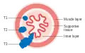 T1, T2, and T3 stages of esophageal cancer