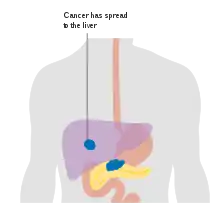 Metastasis – stage M1