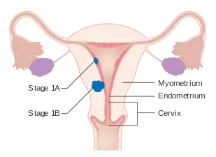 A diagram of stage IA and IB endometrial cancer