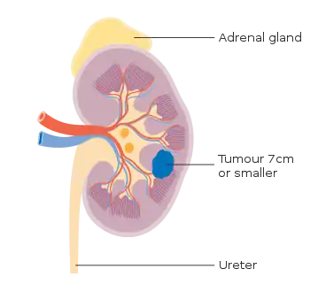 Stage 1 kidney cancer