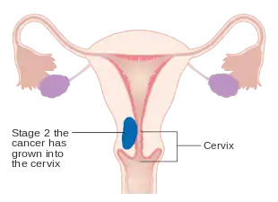 A diagram of stage II endometrial cancer