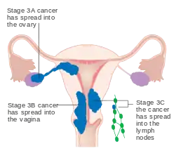 A diagram of stage III endometrial cancer