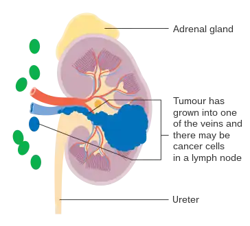 Stage 3 kidney cancer