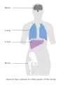 Stage 4 breast cancer