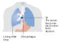 Stage T4 esophageal cancer