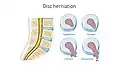 Illustration showing disc degeneration, prolapse, extrusion and sequestration