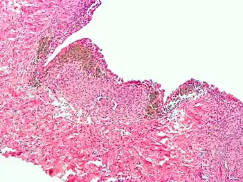 Micrograph of the wall of an endometrioma. All features of endometriosis are present (endometrial glands, endometrial stroma and hemosiderin-laden macrophages).