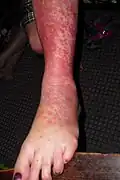 Erythema Multiforme target lesions on the leg