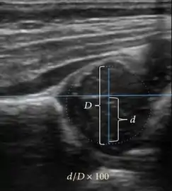 Measurement of femoral head coverage.