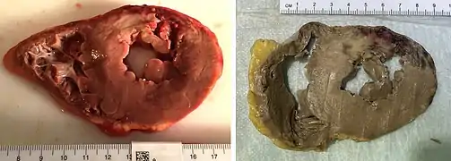 A one-week-old myocardial infarction of the posterior left ventricle, with focal rupture, in fresh state (left) and after formalin fixation (right). The infarcted area is pale whereas the rupture is hemorrhagic (dark red).