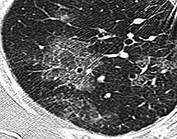 High-resolution computed tomography (HRCT) showing ground-glass attenuation with a geographic or mosaic distribution.