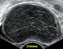 Transvaginal ultrasonography of a hemorrhagic ovarian cyst, probably originating from a corpus luteum cyst. The coagulating blood gives the content a cobweb-like appearance.