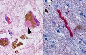 Histological brain sample of Parkinson's patient