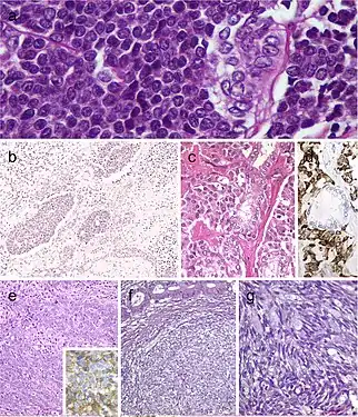 Carcinoma of the thyroid with Ewing family tumor elements (CEFTE) disclosing solid nests of small cells with regular, round nuclei, and nests of papillary thyroid carcinoma (PTC) (a). This case is from a 17-year-old female patient with bilateral involvement of the thyroid by a malignant thyroid teratoma (b); the tumor discloses nests of small cells, rich stroma with chondroid appearance and an epithelial-tubular component. Mixed medullary and papillary thyroid carcinoma (c); the medullary thyroid carcinoma component stained positively for calcitonin mRNA while the PTC (follicular variant) component was negative (d). Intrathyroid thymic carcinoma (ITC) also known by the acronym (CASTLE) showing positivity for CD5 (inset) (e). Spindle epithelial tumor with thymus-like differentiation (SETTLE) is a lobulated tumor composed of spindle cells and epithelioid cell component with glands, mucinous cysts, and/or squamous nests (f and g)