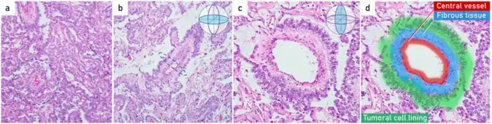 Histopathology of endodermal sinus tumor with Schiller–Duval bodies.(a) papillary pattern combined with small tubopapillary endodermal sinus structure (Schiller–Duval body) in blue circle;(b) marked tubulopapillary sinusoidal structure with central vascular core in longitudinal section (Schiller–Duval body);(c,d) 400× g magnified image plus zoom of diagnostic round cystic Schiller–Duval body in a transverse section, with microcystic and papillary patterns around. The body has a central vessel surrounded by fibrous tissue, called the fibrovascular core, and it is surrounded by layers of the tumoral cells at the surface of that stalk. The structure is located in open cystic space also lined by tumoral cells. All those structures together are called a Schiller–Duval body and resemble primitive glomerulus. H&E stain.