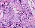 Nuclear grade 1: Oval, mildly enlarged nucleus with evenly distributed chromatin.