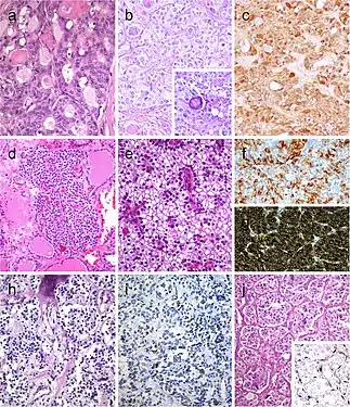 Follicular patterned medullary thyroid carcinoma (MTC) (a). In this other follicular patterned MTC (b), there are several calcifications simulating psammoma bodies (inset) and positivity for calcitonin (c). Intrathyroidal parathyroid tissue (d). The microscopic aspect of an intrathyroidal parathyroid adenoma is similar to eutopic parathyroid adenomas (e). Intrathyroidal parathyroid adenoma expressing chromogranin A (f) and PTH (g). Calcitonin-negative medullary thyroid carcinoma (h) showing positivity for CGRP (i). Paraganglioma (j) typically shows negativity for calcitonin and S100-positive sustentacular cells (inset)