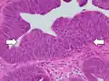 Histopathology of high-grade dysplasia in a tubulovillous adenoma, in this case seen mainly as loss of cell polarity, as cells become more plump and haphazard than the elongated and parallel nuclei of surrounding low-grade dysplasia.