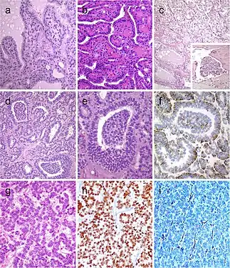 Hyperfunctioning follicular adenoma typically shows follicles with papillary infoldings and bubbly, pale colloid with peripheral scalloping (a). Non-hyperfunctioning adenomas with papillary hyperplasia usually show a more predominantly papillary pattern without vacuolated cytoplasm and scalloping colloid (b). Rare hyperfunctioning follicular tumors (c) can show capsular and/or venous invasion (inset); the nuclei are very clear which may be associated to hyperfunctioning. The glomeruloid pattern in this follicular thyroid carcinoma (FTC) included follicles with round to oval tufts growing within, at times supported by a fibrovascular core mimicking the renal glomerulus (d and e); empty follicles were lined by columnar cells with marked pseudostratification, and positivity for CK18 was detected (f). FTC (g) with TTF1 expression (h) and very focal expression of thyroglobulin i