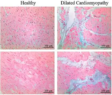 Micrograph of healthy myocardium versus interstitial fibrosis in dilated cardiomyopathy. Alcian blue stain. The fibrosis is either evenly distributed between myocytes or follows anatomic structures such as blood vessels.