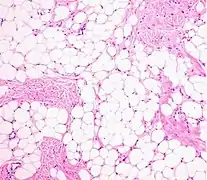 Histopathology of a lipoma: The mass is composed of lobules of mature white adipose tissue divided by fibrous septa containing thin-walled capillary-sized vessels.[predatory publisher] H&E stain.