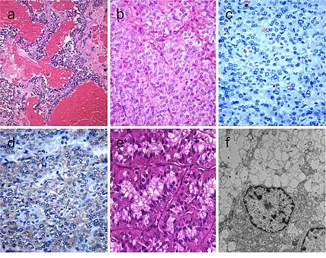 Medullary thyroid carcinoma with papillary pattern (a). Solid variant of papillary thyroid carcinoma (b) with focal expression of thyroglobulin (c) and expression of T4 (d); in this case, TTF1 was diffusely expressed. Biphasic Hürthle cell (oncocytic) clear carcinoma in which the basal half of the cytoplasm is oncocytic, whereas the upper half is clear (e), due to the swelling of the mitochondria (ultrastructure) (f)