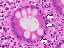 Neutrophilic cryptitis (neutrophils within crypt epithelium)