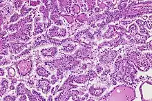 Gross appearance of Papillary renal cell carcinoma