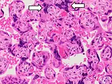 Histopathology of placenta with increased syncytial knotting of chorionic villi, with two knots pointed out.