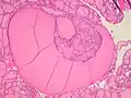 Thyroid hyperplasia with a Sanderson polster, which is a group of small follicles that protrude into the lumen of a larger follicle.  It should not be confused for papillary projections.