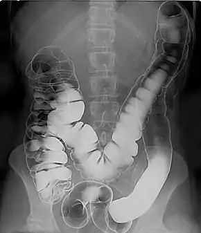 Double contrast barium enema - Using positive and negative contrast