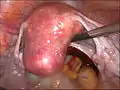 Uterus prior to hysterectomy