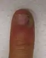 An infection of the cuticle secondary to a splinter