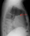 A pleural effusion as seen on lateral upright chest x-ray