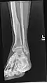 X-ray avulsion fracture of the summit of the left lateral malleolus.